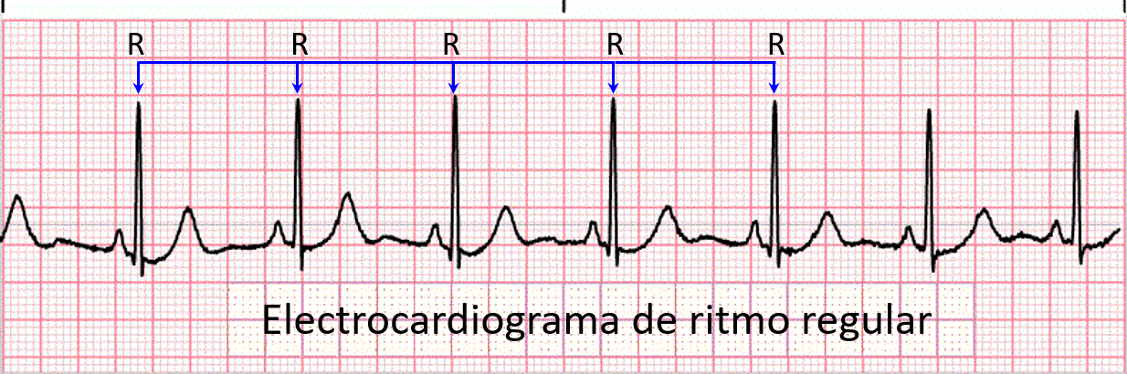 EKG ritmo regular EKG ritmo regular